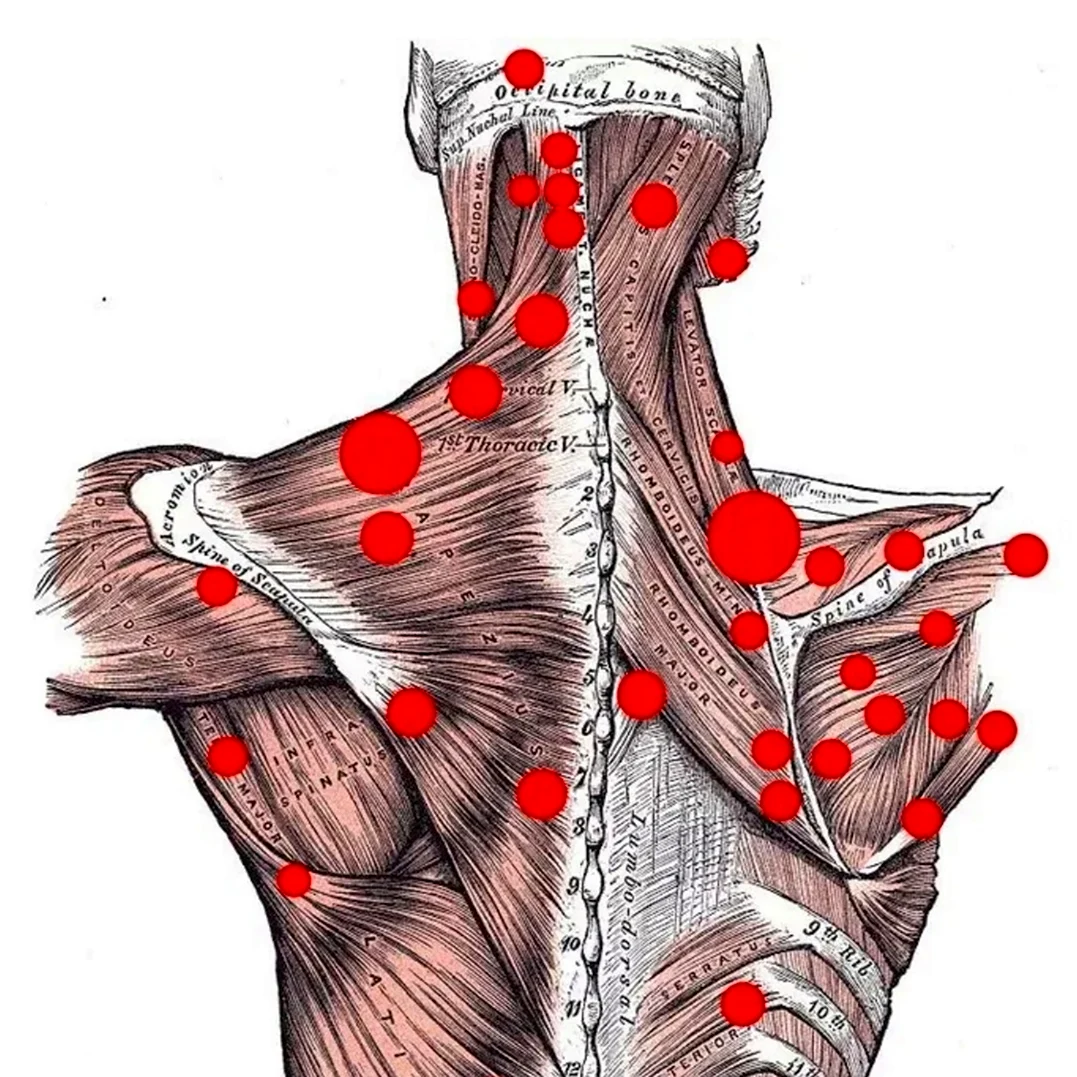 Триггерные точки в грудной мышце. Миофасциальный синдром триггерные точки. Триггерные точки на спине. Триггерные точки грушевидной мышцы.